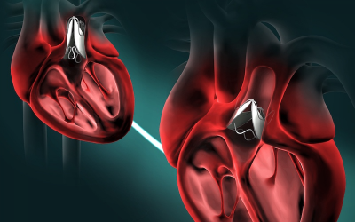 Global prosthetic heart valve market set to more than double by 2033
